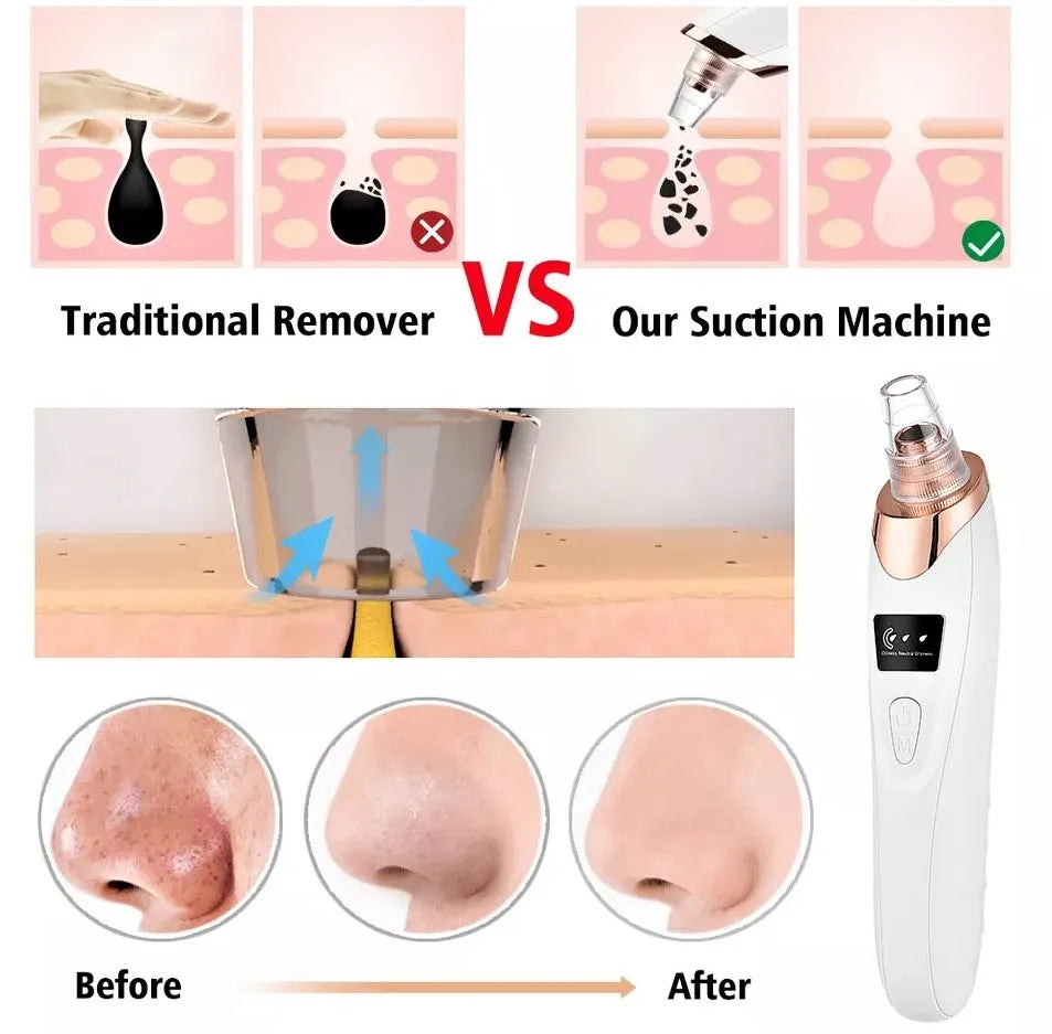 5-in-1 Blackhead Remover Machine Rechargeable – Face Pore Vacuum Suction Cleaner with 5 Replacement Heads