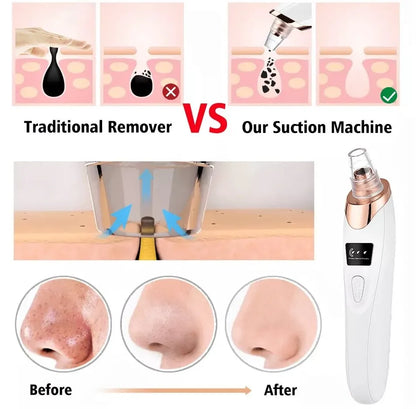5-in-1 Blackhead Remover Machine Rechargeable – Face Pore Vacuum Suction Cleaner with 5 Replacement Heads